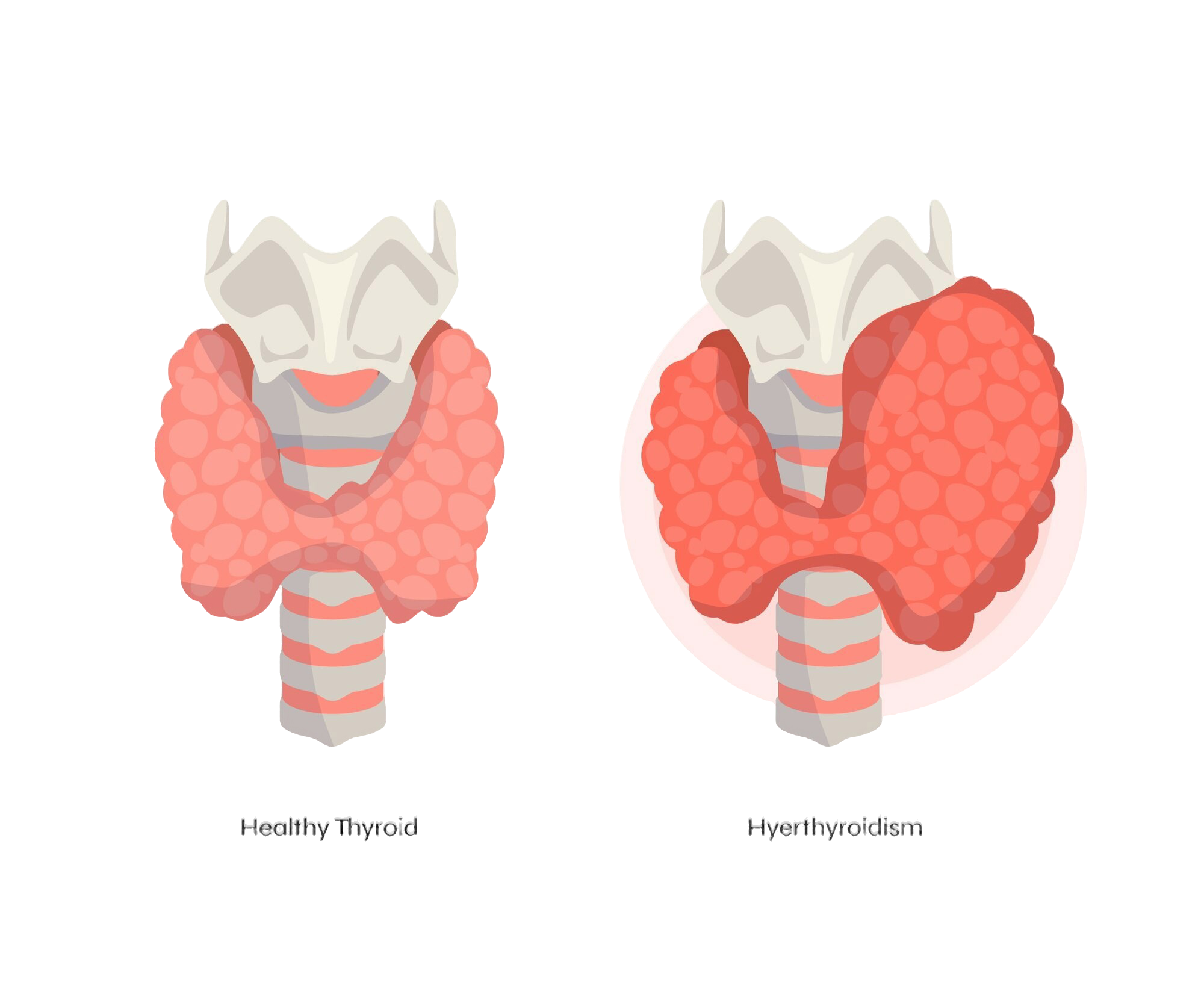 Thyroid disease Thyroid disease